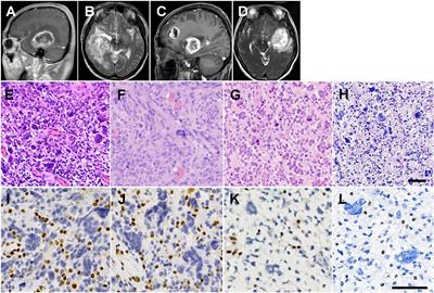 Characteristics of glioblastomas and immune microenvironment in a Chinese family with Lynch syndrome and concurrent porokeratosis